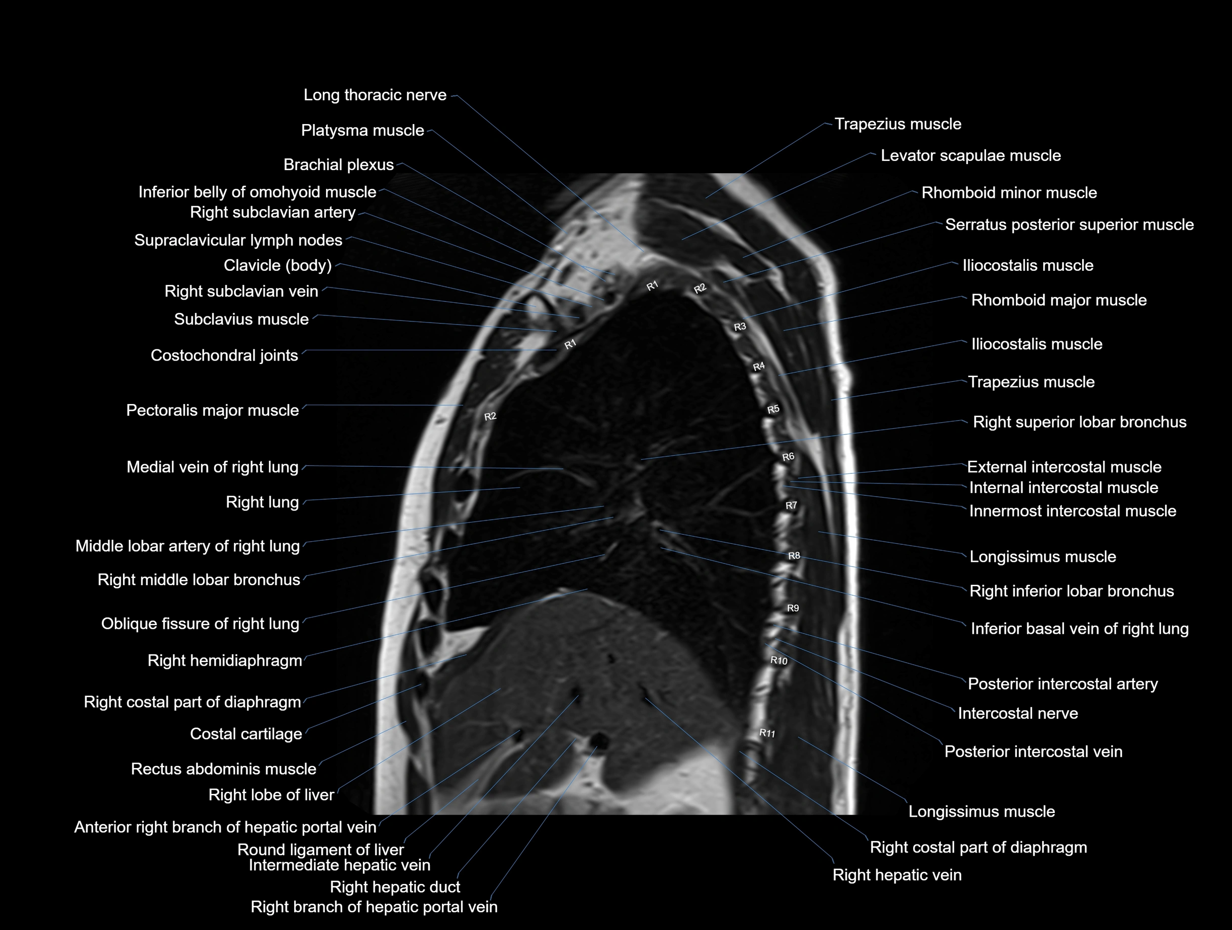 MRI chest (thorax) coronal  cross sectional anatomy 3T radiology  image-img-00001-00014.webp